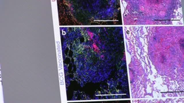 Tulane Tuberculosis Study