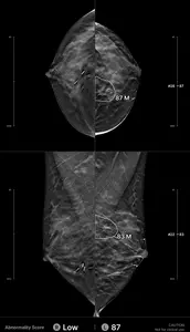 Example of an interval cancer retrospectively detected by the AI algorithm
