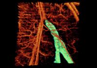 Blocked Vein