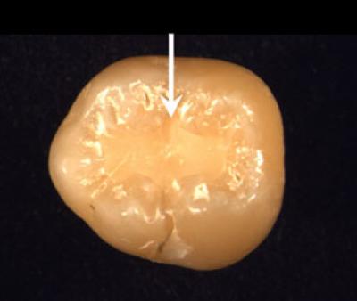 A Stronger Dental Material