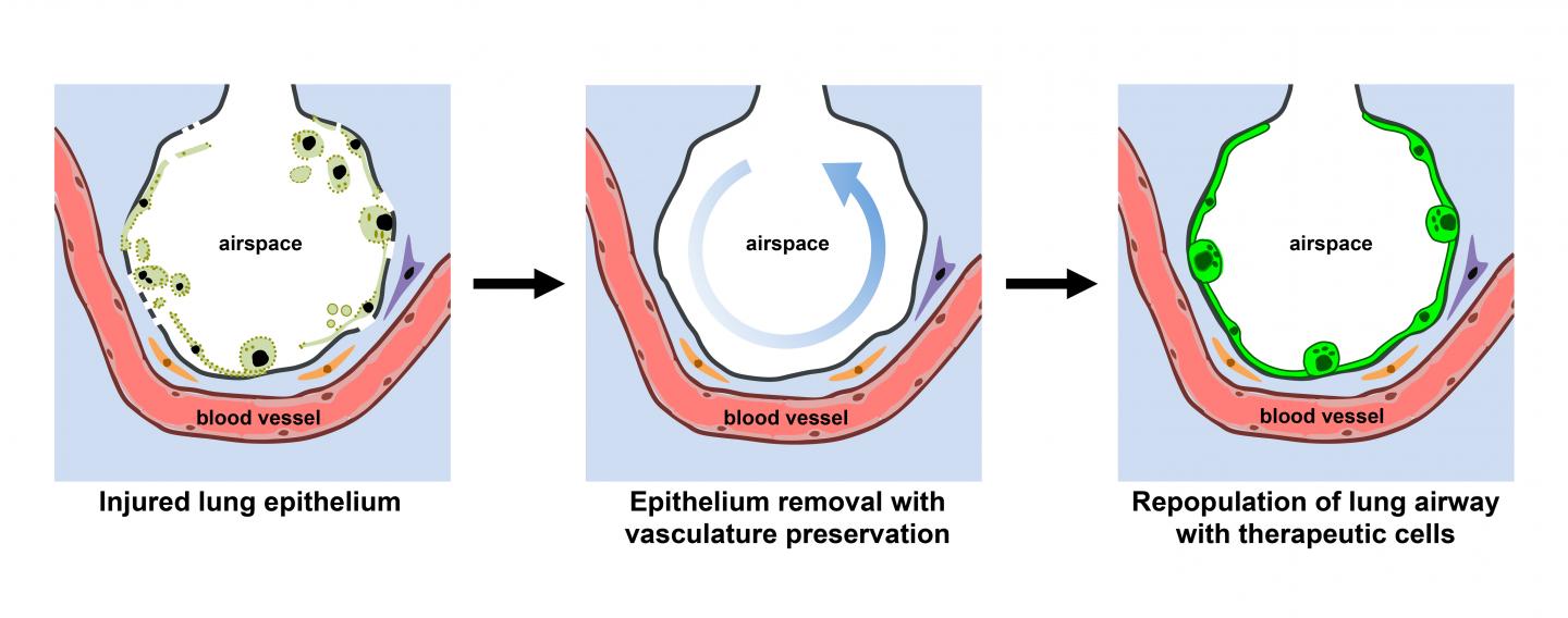 A New Approach Sets Lung Grafts Up for Success (2 of 6)