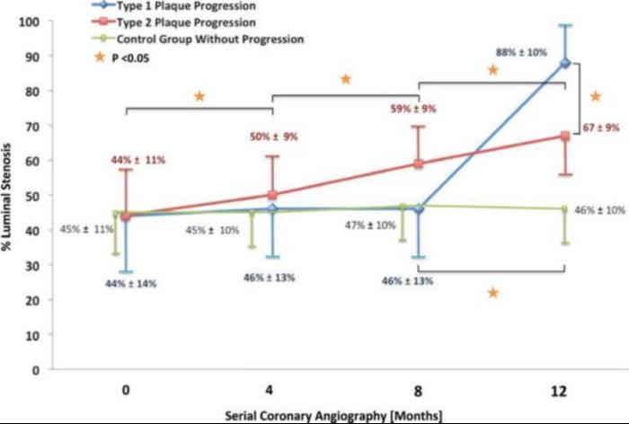 Plaque progression determines the clinical event.
