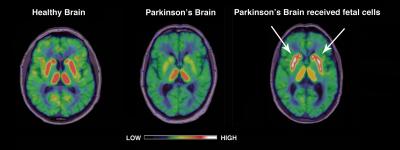 Serotonin Solves Decades-Old Mystery in Parkinson's Disease (1 of 4)
