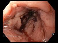 Colon with Crohn's Disease