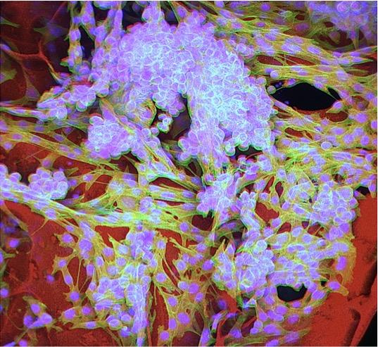Cancer Cells Embedded in Cryogel