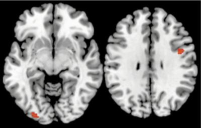 Unconscious Activity in 2 Parts of the Brain