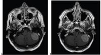 88-Year-Old Woman With Left Posterior Fossa Meningioma