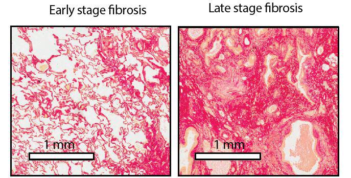 A New Imaging Tool Can Detect and Monitor Lung Damage Earlier (2of 4)