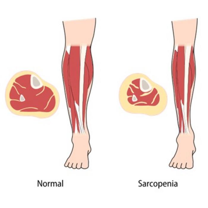 Loss of Muscle Mass in Rheumatoid Arthritis
