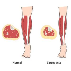Loss of Muscle Mass in Rheumatoid Arthritis