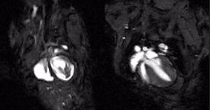 teaser of mouse beating heart