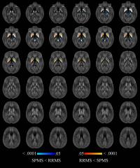Quantitative Susceptibility Maps w/in Thalamus, Caudate, Globus Pallidus, & Putamen (2 of 3)