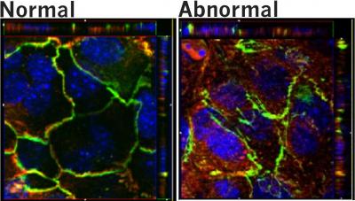 Normal and Abnormal Breastmilk Cells (1 of 3)
