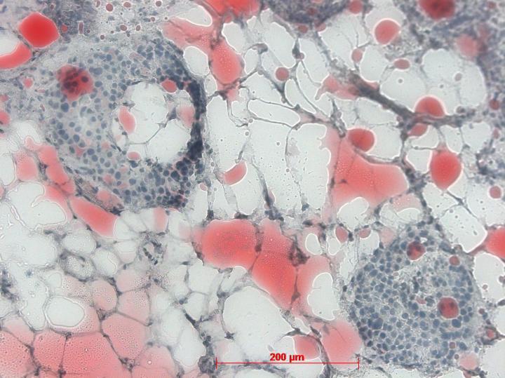 Organ Crosstalk: Fatty Liver Can Cause Damage to Other Organs