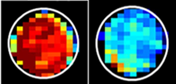 MRI of Healthy Cells Vs. Cancer Cells
