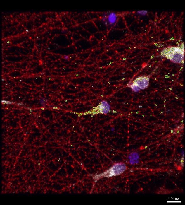 fragile_x_neurons.jpg