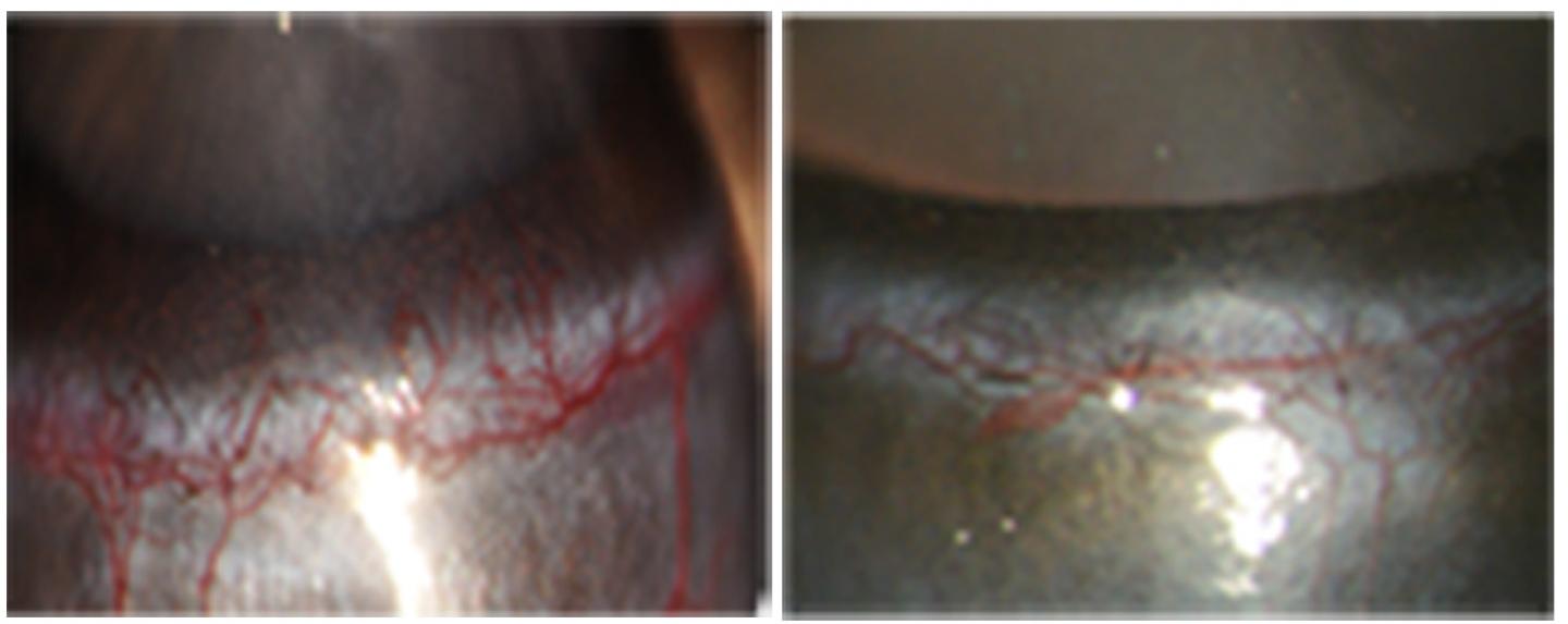 Secretogranin III Promotes Blood Vessel Formation in Diabetic Mice