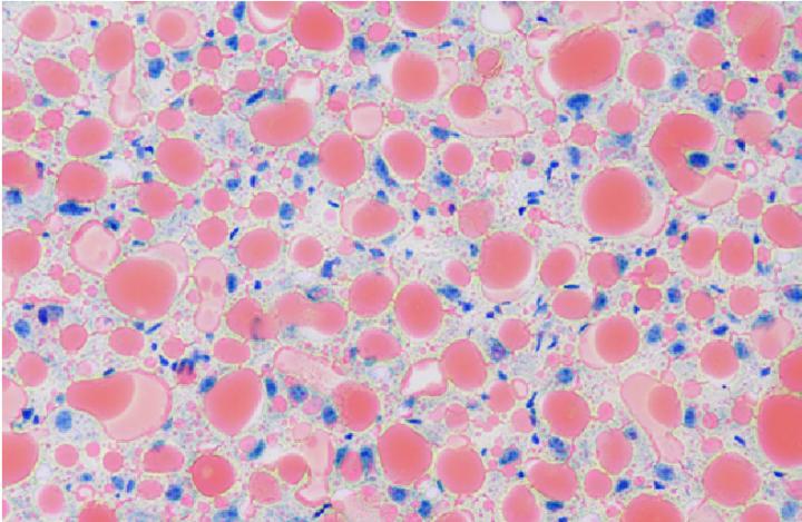 Fatty Liver