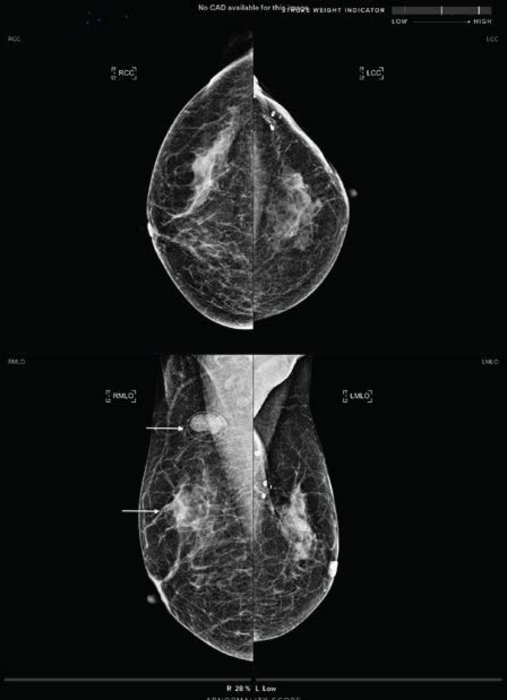 60-Year-Old Woman With Post-BCT in Left Breast for Invasive Ductal Carcinoma