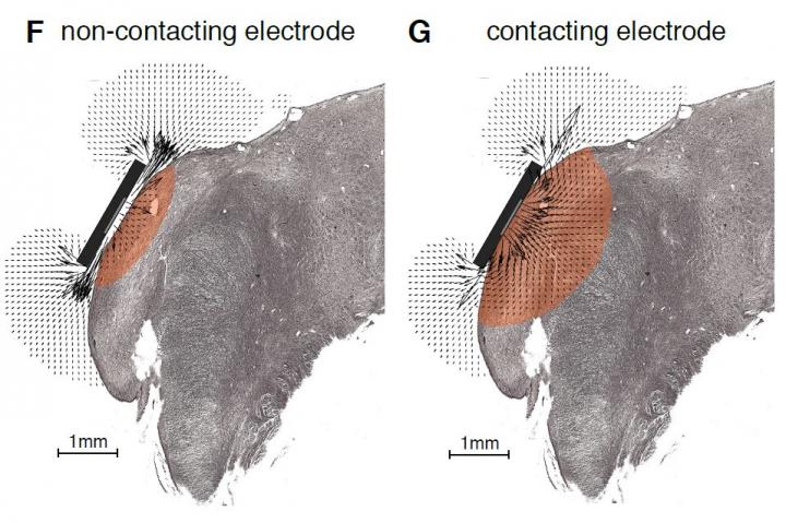 Soft Implants for Deafness Better Interface with the Brainstem (1 of 8)