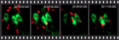 New Findings on Multiple Sclerosis -- Immune Cells Also Attack Neurons Directly