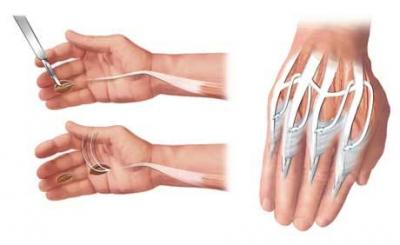 New Method Restores Grip Function More Quickly to Patients with Tetraplegia