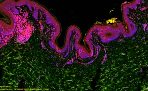 inflammatory skin disease hidradenitis suppurativa