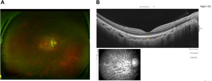 A) Pseudocolor fundus image obtained by Optos. B) Choroidal thickness measurement at the fovea