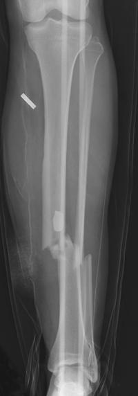 Fracture Photo