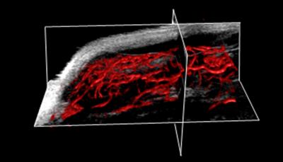 Acoustic Angiography Image