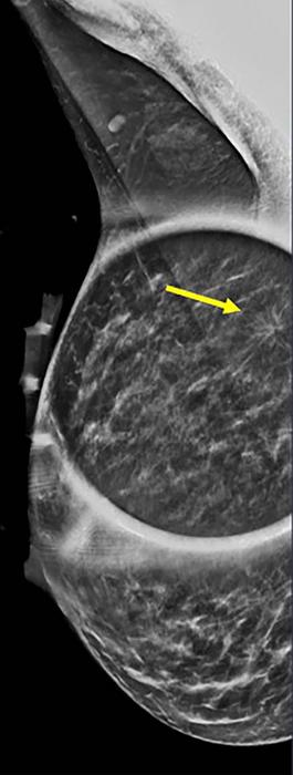 Mammogram shows spot on right mediolateral oblique (side angle) view.