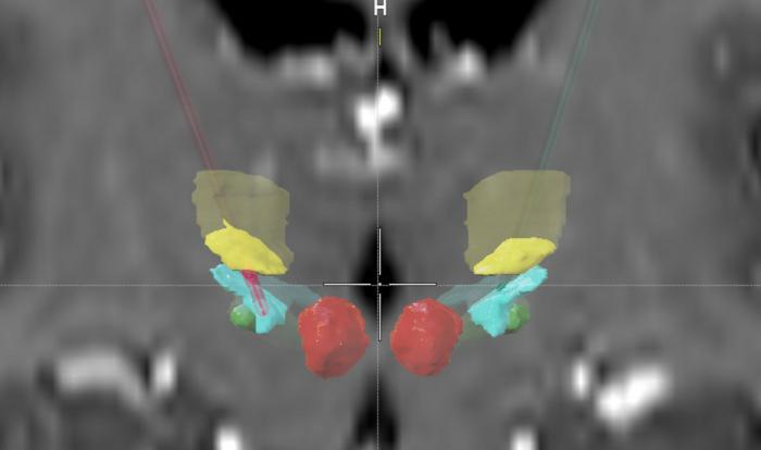 Position of the implanted electrodes in the patient’s basal ganglia.