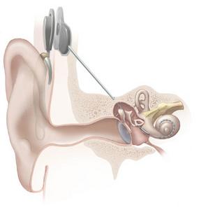 An illustration of a cochlear implant from the National Institute on Deafness and Other Communication Disorders at the National Institutes of Health