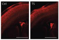 Corpus Callosum
