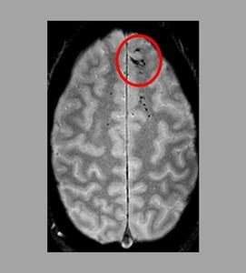 Neural Stem Cells in Traumatic Brain Injury