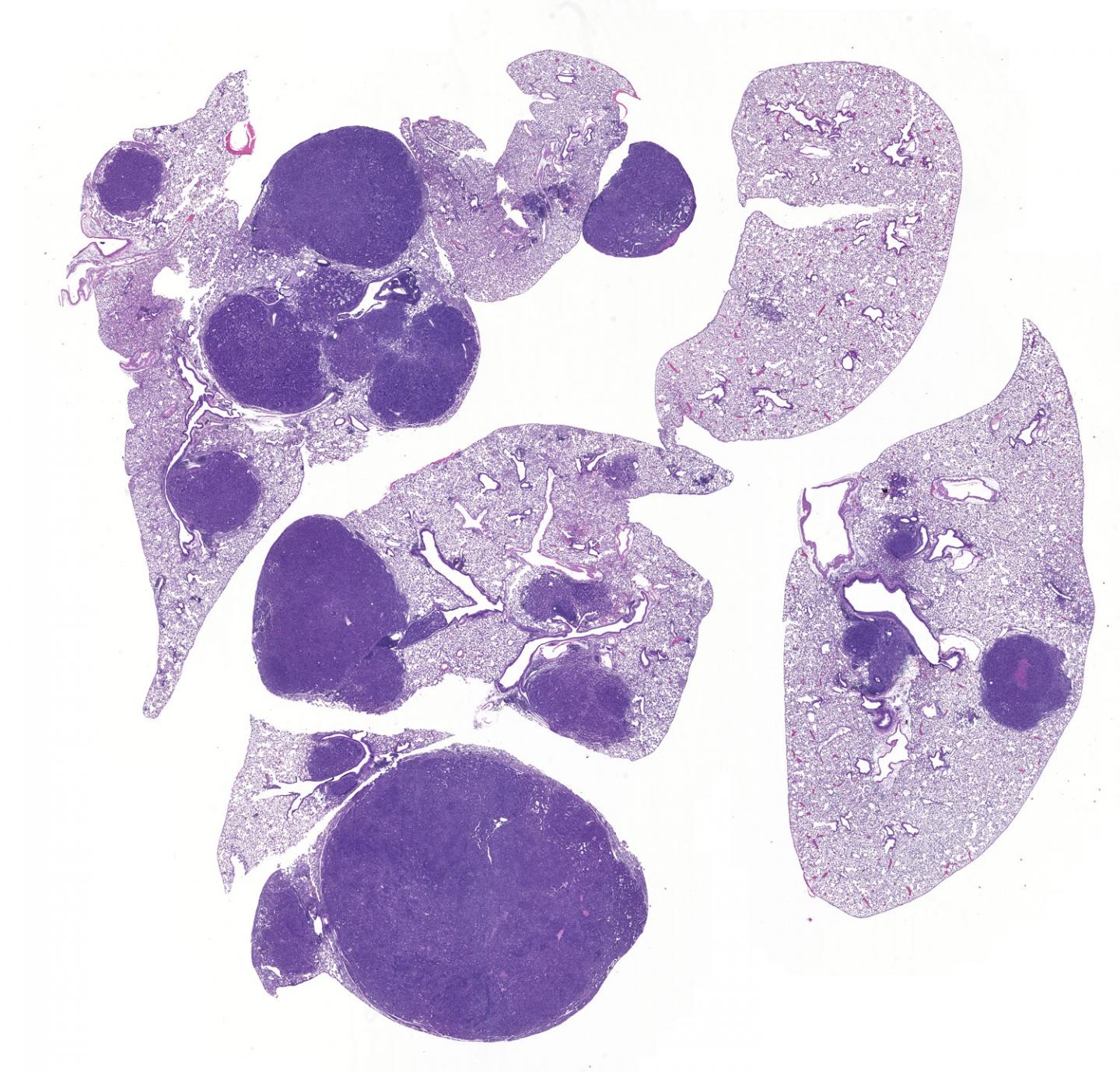 Lung Tumors