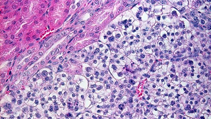 Clear Cell Renal Cell Carcinoma in a Mouse