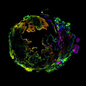 Cell abnormalities