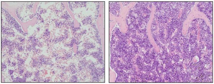 Aplastic Anemia