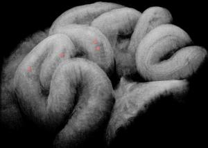 in vivo 3D OCT image