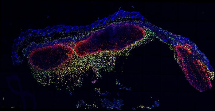 Melanoma microscopy