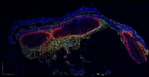 Melanoma microscopy
