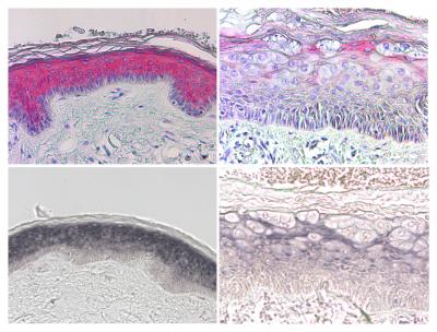 Scientists Uncover Potential Mechanism for HPV-Induced Skin Cancer