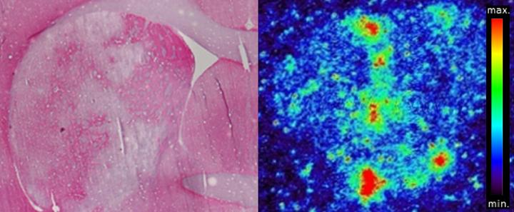 Sweet Nanoparticles Target Stroke (2 of 2)