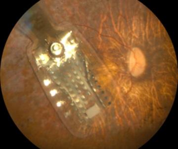 After Blindness, the Adult Brain Can Learn to See Again