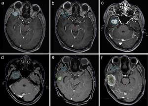 This figure illustrates a patient who had previously undergone two resections and one EBRT before undergoing GKRS for two recurrences