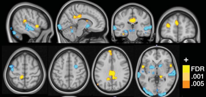 fMRI Fibromyalgia