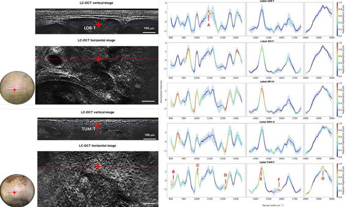 Line-field confocal optical coherence tomography (LC-OCT) captures high-resolution images of skin tissue at the cellular level, and then confocal Raman microspectroscopy analyzes the chemical makeup of specific areas identified in those images.