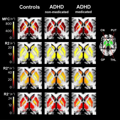 Brain Iron Measures