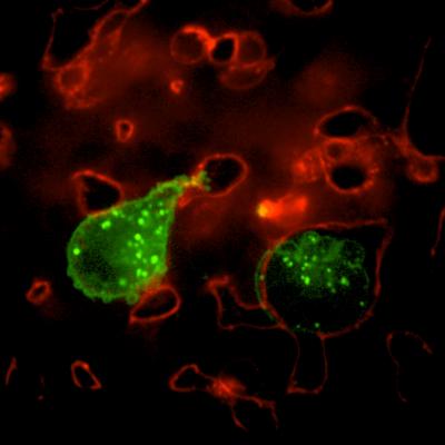 Invadopodia in Tumor Cell